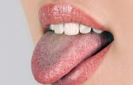 জিহ্বা সাদা হলে যেসব রোগের ইঙ্গিত দেয়